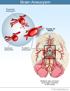 2011-brain-aneurysm